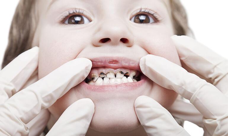 علائم پوسیدگی دندان کودکان و اطفال و روش‌های جلوگیری از آن